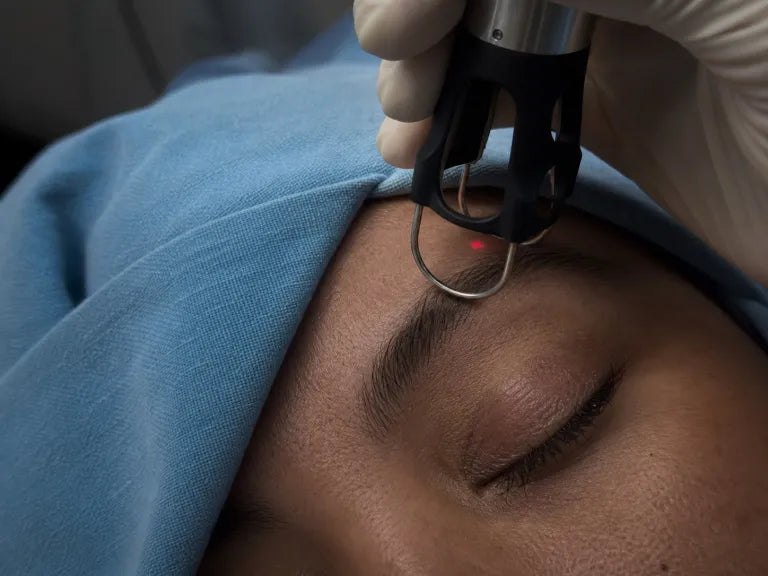 Tratamiento periocular con tecnología CO2 en OculoPlast
