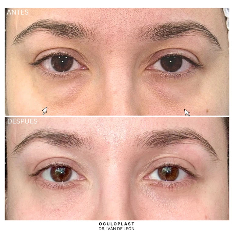 Comparativa clínica antes y después de blefaroplastia inferior con láser CO₂ a los 12 días postoperatorios