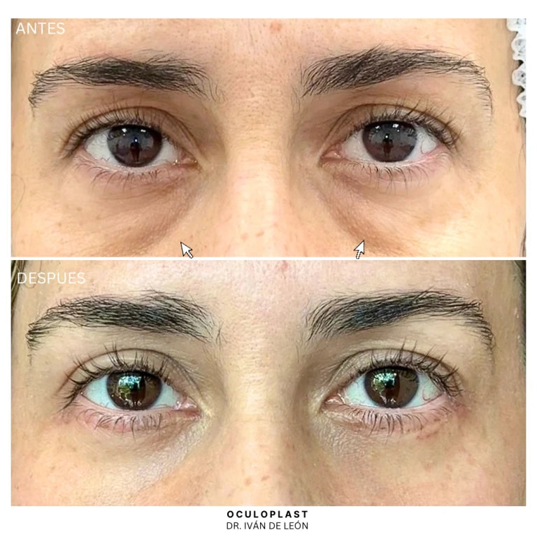 Comparativa clínica antes y después de blefaroplastia inferior con láser CO₂ a los 12 días postoperatorios