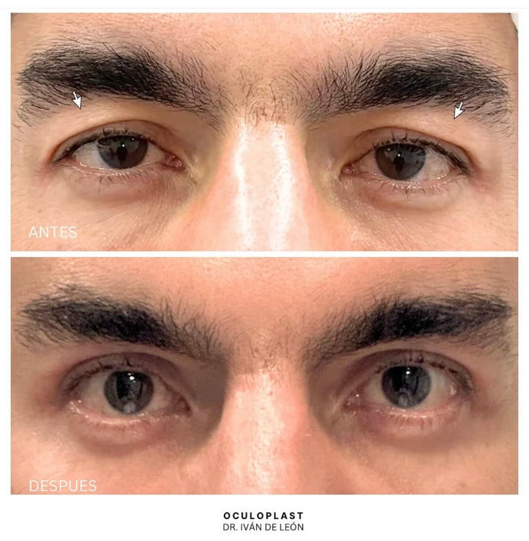 Comparativa clínica antes y después de blefaroplastia superior con láser CO₂ a los 3 meses postoperatorios