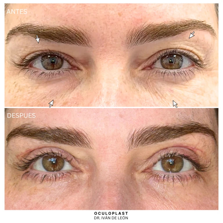 Comparativa clínica antes y después de blefaroplastia superior e inferior con láser CO₂ a los 12 días postoperatorios
