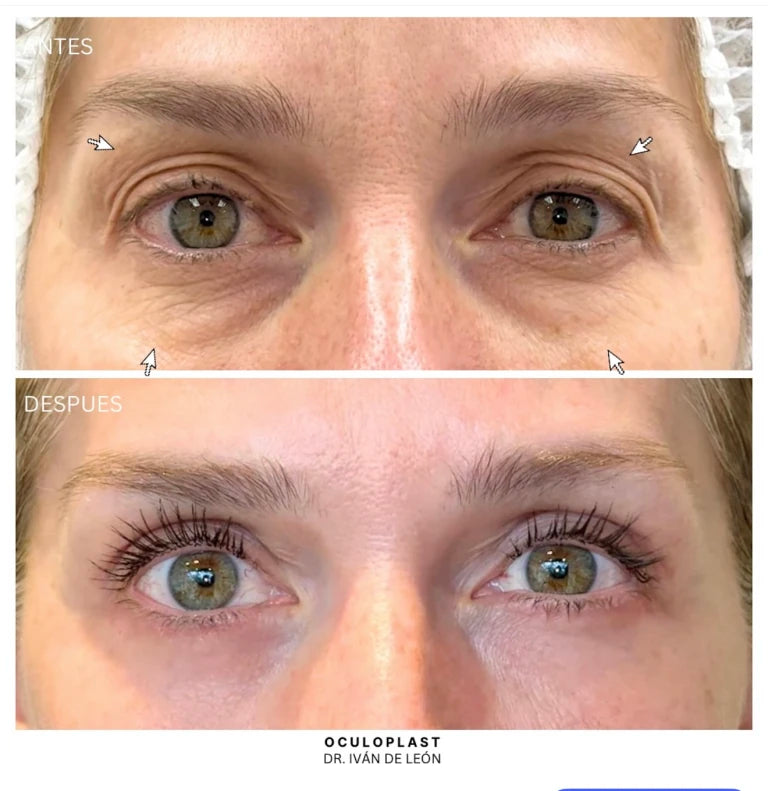 Comparativa clínica antes y después de blefaroplastia superior e inferior con láser CO₂ a los 12 días postoperatorios