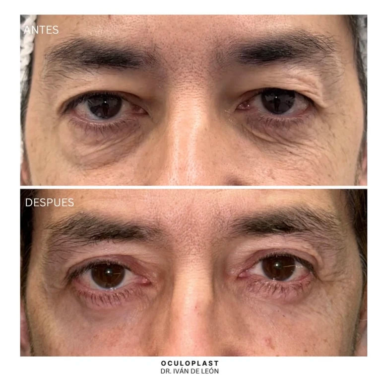 Comparativa clínica antes y después de blefaroplastia superior e inferior con láser CO₂ a los 12 días postoperatorios