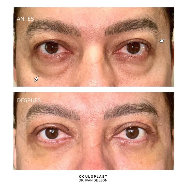 Comparativa clínica antes y después de blefaroplastia superior e inferior con láser CO₂ a los 12 días postoperatorios