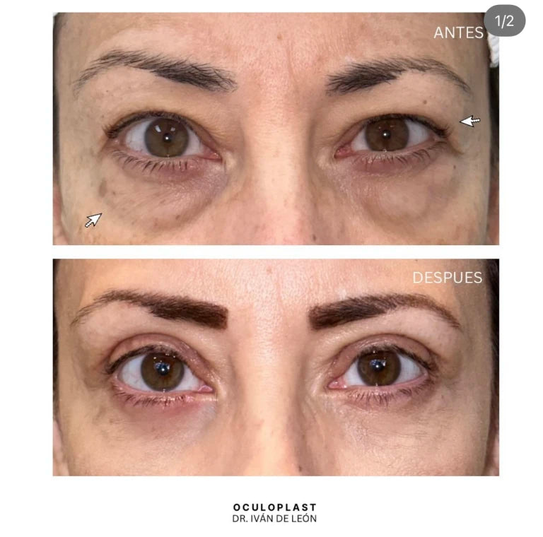 Comparativa clínica antes y después de blefaroplastia superior e inferior con láser CO₂ a los 12 días postoperatorios