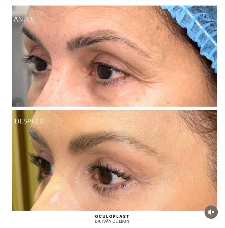 Comparativa clínica antes y después de blefaroplastia superior e inferior, lifting lateral de ceja y láser CO₂ a los 14 días postoperatorios