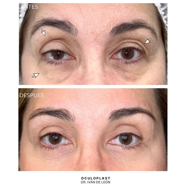 Comparativa clínica antes y después de blefaroplastia superior e inferior, corrección de ptosis y láser CO₂ a los 12 días postoperatorios